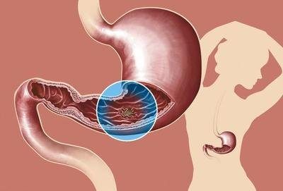 做好這些|慢性萎縮性胃炎離胃癌就會(huì)更遠(yuǎn)！